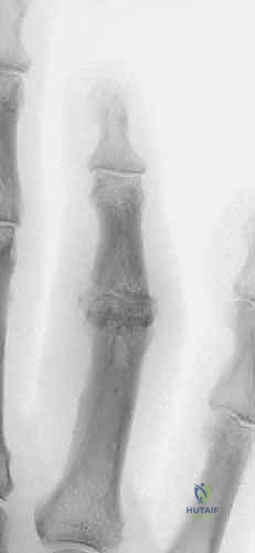 صورة توضيحية لـ التثبيت الخارجي الديناميكي لكسور وخلوع مفصل PIP