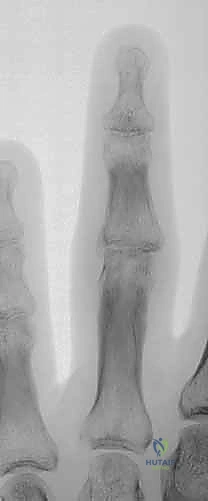 صورة توضح الطرف البعيد للسلامية الدانية، وهو سطح محدب