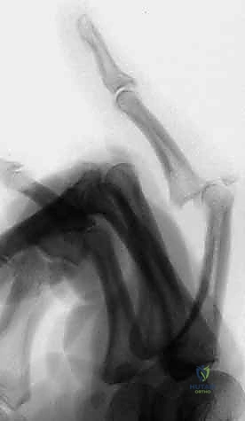 صورة توضح خلعًا راحيًا آخر في مفصل PIP