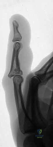 صورة توضح خلعًا راحيًا في مفصل PIP