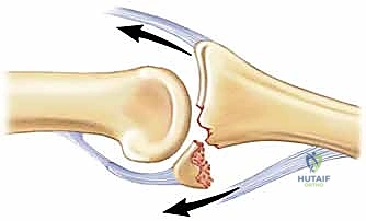رسم توضيحي للميكانيكا الحيوية للمفصل