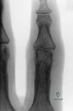 صورة توضح إدخال السلك الأول بدقة