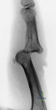 صورة لإدخال السلك الثاني