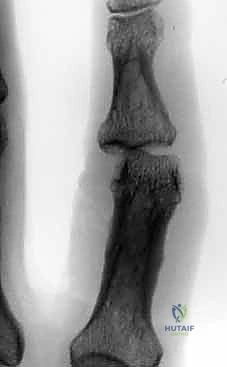 صورة توضح الأسلاك بعد إدخالها