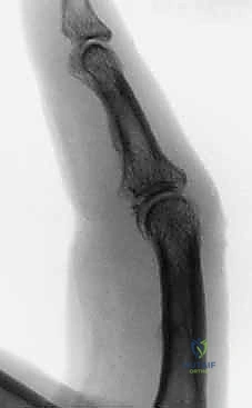 صورة لتجميع الإطار الجراحي