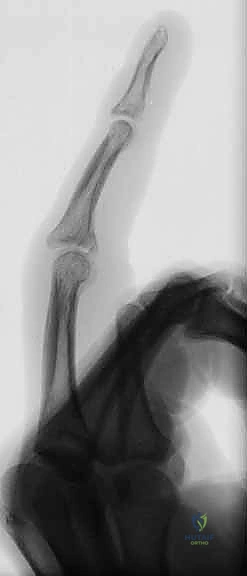 صورة توضح ميكانيكية عدم الاستقرار