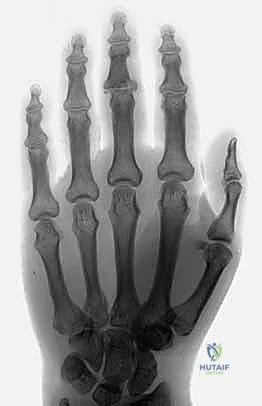 صورة للأدوات المستخدمة في التثبيت الخارجي