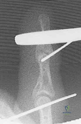 صورة لكسر خلع ظهري شديد في مفصل PIP