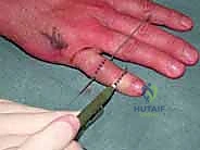 صور توضح كسور البايلون في مفصل PIP