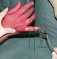 صورة طبية: التثبيت الخارجي الديناميكي لكسور وخلوع مفصل PIP: دليل شامل لاستعادة حركة الأصابع مع الأستاذ الدكتور محمد هطيف