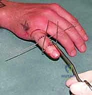 صورة توضيحية لـ التثبيت الخارجي الديناميكي لكسور وخلوع مفصل PIP: دليل شامل لاستعادة حركة الأصابع مع الأستاذ الدكتور محمد هطيف