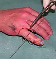 صورة توضيحية لـ التثبيت الخارجي الديناميكي لكسور وخلوع مفصل PIP: دليل شامل لاستعادة حركة الأصابع مع الأستاذ الدكتور محمد هطيف