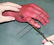 صورة توضيحية لـ التثبيت الخارجي الديناميكي لكسور وخلوع مفصل PIP: دليل شامل لاستعادة حركة الأصابع مع الأستاذ الدكتور محمد هطيف