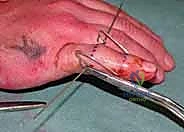 صورة طبية: التثبيت الخارجي الديناميكي لكسور وخلوع مفصل PIP: دليل شامل لاستعادة حركة الأصابع مع الأستاذ الدكتور محمد هطيف