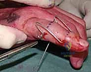 صورة توضيحية لـ التثبيت الخارجي الديناميكي لكسور وخلوع مفصل PIP: دليل شامل لاستعادة حركة الأصابع مع الأستاذ الدكتور محمد هطيف