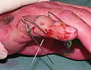 صورة طبية: التثبيت الخارجي الديناميكي لكسور وخلوع مفصل PIP: دليل شامل لاستعادة حركة الأصابع مع الأستاذ الدكتور محمد هطيف