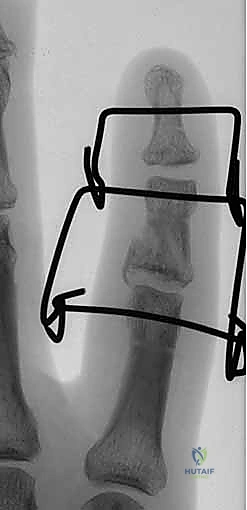 صورة طبية: التثبيت الخارجي الديناميكي لكسور وخلوع مفصل PIP: دليل شامل لاستعادة حركة الأصابع مع الأستاذ الدكتور محمد هطيف