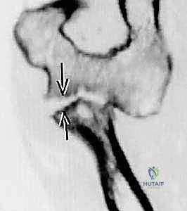 ABOS Part I Orthopedic Surgery Board Review: Trauma, Fractures & Ewing's Sarcoma MCQs | Part 21595