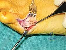 استخدام الوسائد الطبية