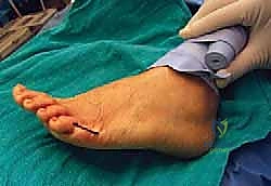 تقييم حالة ورم الخياط