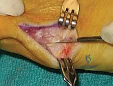 مقارنة أورام القدم