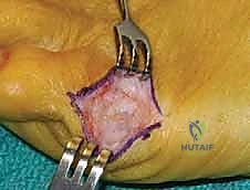 أعراض ورم الخياط