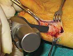 التحضير للجراحة