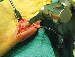 صورة توضيحية لـ ورم إصبع القدم الصغير (Bunionette): دليلك الشامل للعلاج والتعافي مع الأستاذ الدكتور محمد هطيف