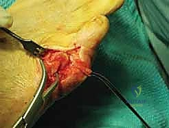 خطوات قطع العظم