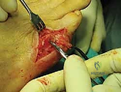 صورة توضيحية لـ ورم إصبع القدم الصغير (Bunionette): دليلك الشامل للعلاج والتعافي مع الأستاذ الدكتور محمد هطيف