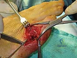 صورة توضيحية لـ ورم إصبع القدم الصغير (Bunionette): دليلك الشامل للعلاج والتعافي مع الأستاذ الدكتور محمد هطيف