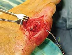 صورة توضيحية لـ ورم إصبع القدم الصغير (Bunionette): دليلك الشامل للعلاج والتعافي مع الأستاذ الدكتور محمد هطيف