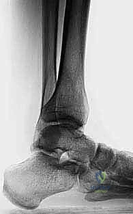 قطع عظم الساق فوق الكاحل: الحل الأمثل لتشوهات الكاحل المعقدة مع الأستاذ الدكتور محمد هطيف