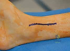 تشريح مفصل الكاحل وعظام الساق