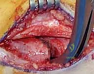 استخدام الشرائح والمسامير لتثبيت العظم