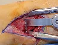 التخطيط الجراحي قبل عملية قطع العظم