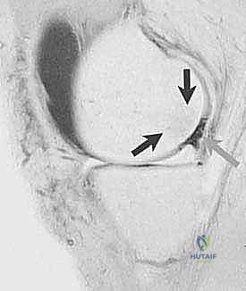 طبقات الغضروف والافتقار للأوعية الدموية
