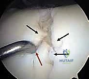 تكوين الجلطة الدموية الفائقة في موقع الإصابة