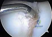 تجميل الغضروف بالوخز المجهري استعادة مرونة الركبة تحت إشراف الأستاذ الدكتور محمد هطيف