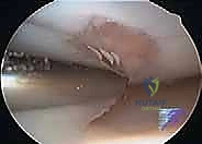 الأستاذ الدكتور محمد هطيف أثناء إجراء جراحة بالمنظار