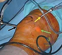 صورة توضيحية لـ تجميل الغضروف بالوخز المجهري استعادة مرونة الركبة تحت إشراف الأستاذ الدكتور محمد هطيف