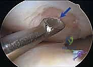 صورة توضيحية لـ تجميل الغضروف بالوخز المجهري استعادة مرونة الركبة تحت إشراف الأستاذ الدكتور محمد هطيف