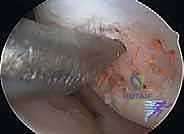 صورة توضيحية لـ تجميل الغضروف بالوخز المجهري استعادة مرونة الركبة تحت إشراف الأستاذ الدكتور محمد هطيف