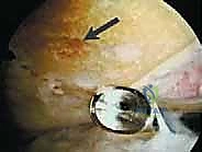 صورة طبية: تجميل الغضروف بالوخز المجهري استعادة مرونة الركبة تحت إشراف الأستاذ الدكتور محمد هطيف
