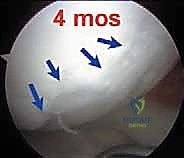 صورة طبية: تجميل الغضروف بالوخز المجهري استعادة مرونة الركبة تحت إشراف الأستاذ الدكتور محمد هطيف