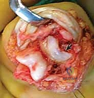 صورة توضيحية للأربطة والأنسجة الرخوة في مفصل PIP