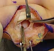 كسر خلع مفصل الإصبع الأوسط (PIP): دليل شامل للتشخيص والعلاج الجراحي مع الأستاذ الدكتور محمد هطيف