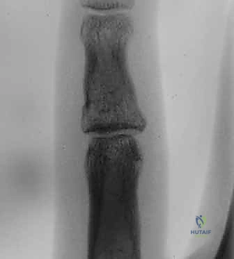 صورة توضيحية لـ كسر خلع مفصل الإصبع الأوسط (PIP): دليل شامل للتشخيص والعلاج الجراحي مع الأستاذ الدكتور محمد هطيف