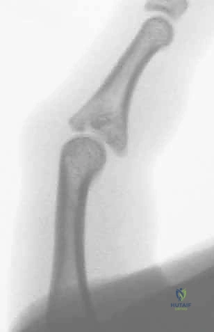 صورة طبية: كسر خلع مفصل الإصبع الأوسط (PIP): دليل شامل للتشخيص والعلاج الجراحي مع الأستاذ الدكتور محمد هطيف