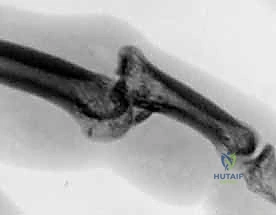 صورة طبية: كسر خلع مفصل الإصبع الأوسط (PIP): دليل شامل للتشخيص والعلاج الجراحي مع الأستاذ الدكتور محمد هطيف